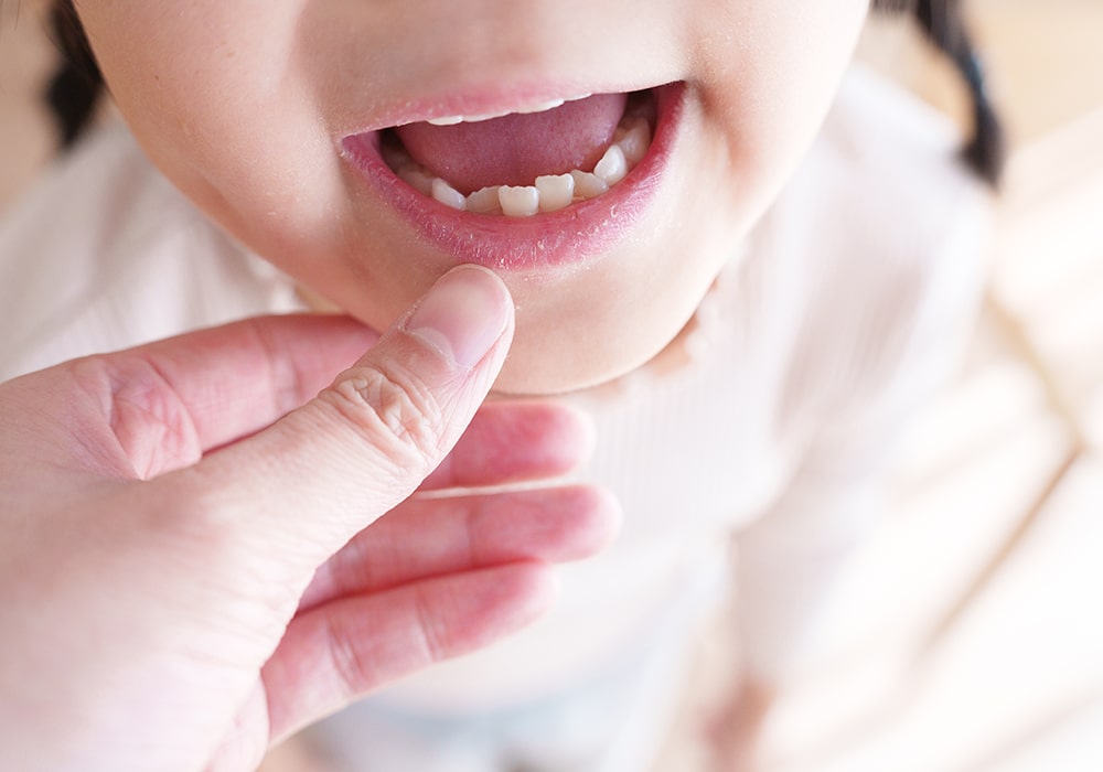 歯並びが悪くなる