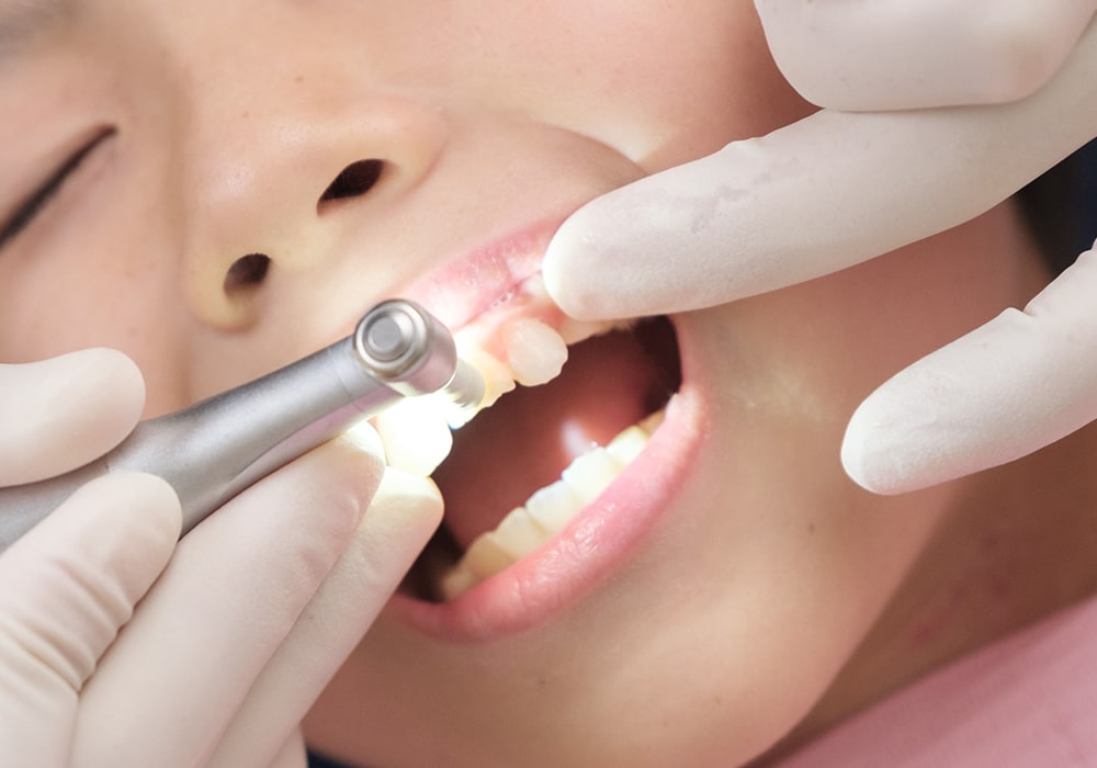 むし歯予防に効果的な方法