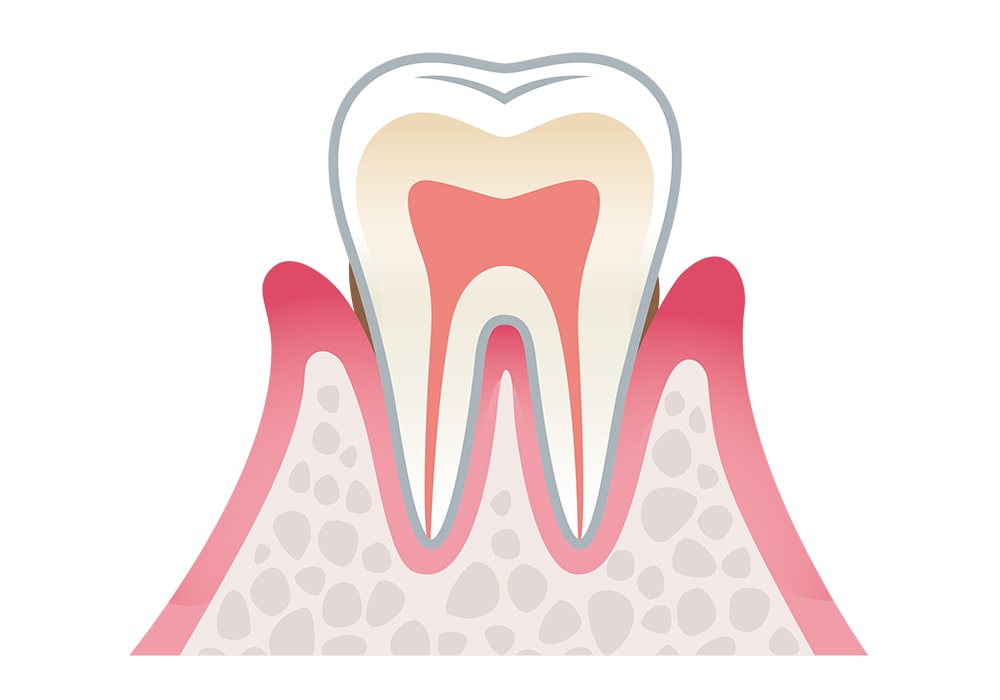 歯周炎（軽度）