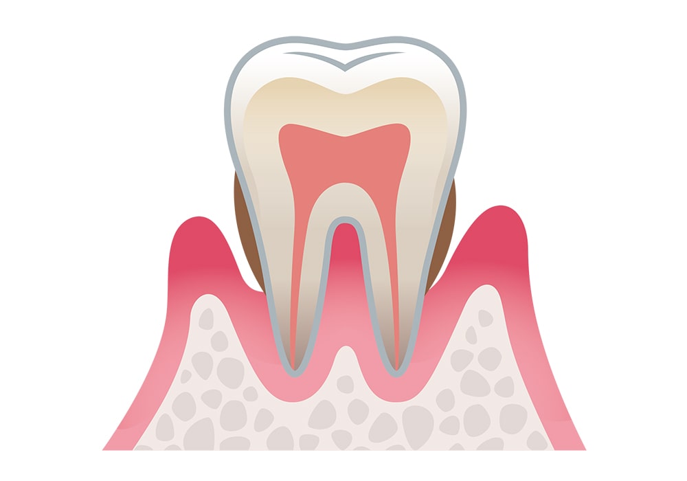 歯周炎（中度）