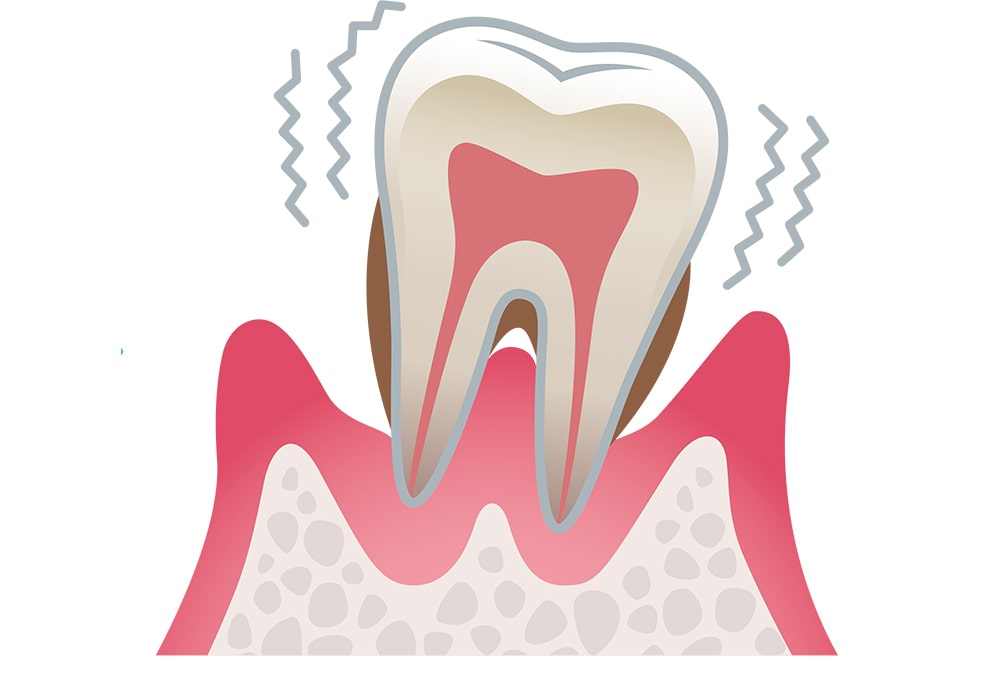 歯周炎（重度）